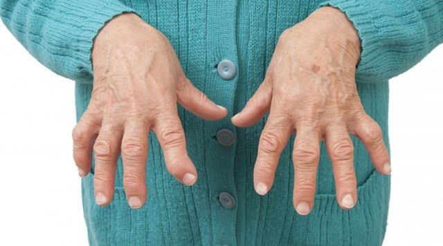 Viêm khớp vảy nến: Nguyên nhân, triệu chứng và cách điều trị
