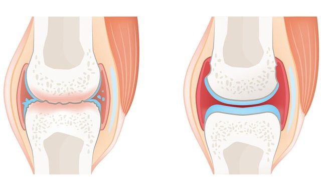Viêm khớp: triệu chứng, cách chẩn đoán và điều trị