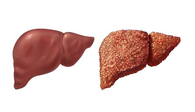 Xơ gan mất bù còn điều trị được không?