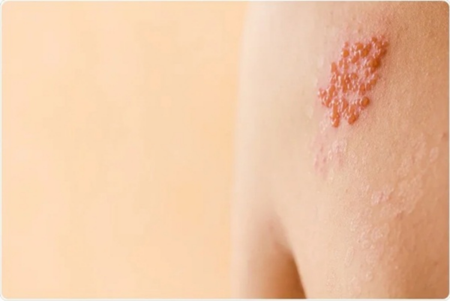 Những điều cần biết về bệnh zona thần kinh ở người nhiễm HIV
