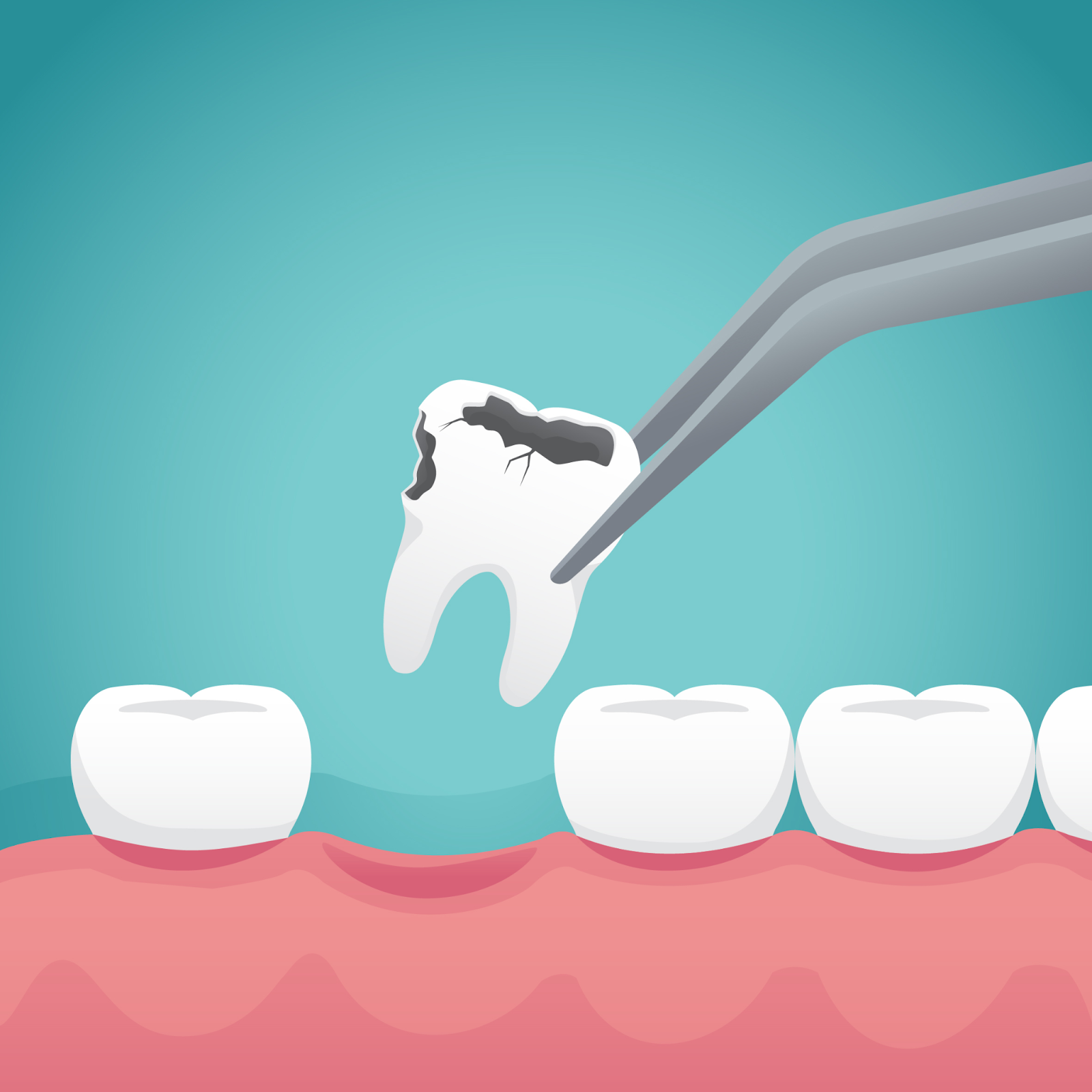 Cắm Implant tức thì ngay sau khi nhổ răng cho hiệu quả nhanh chóng hơn so với việc cắm Implant sau khi lành xương