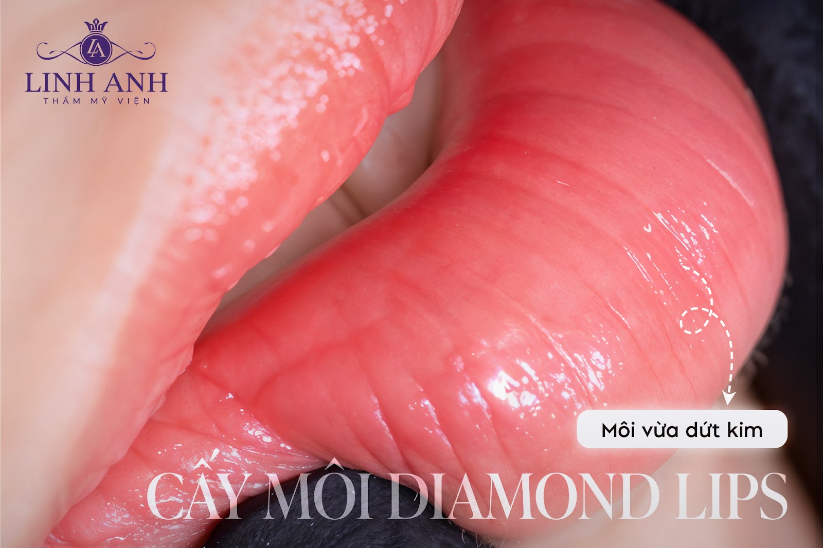 Công nghệ cấy môi Diamond Lips mang lại đôi môi căng mọng, tươi tắn