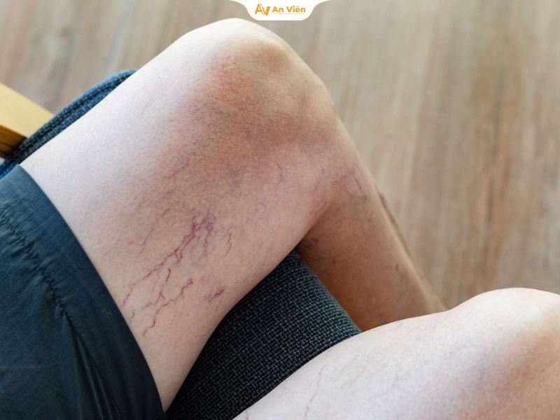 Những mạch máu nổi rõ, ngoằn ngoèo xuất hiện ở chân