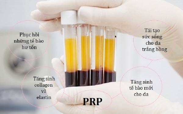 Tiêm PRP